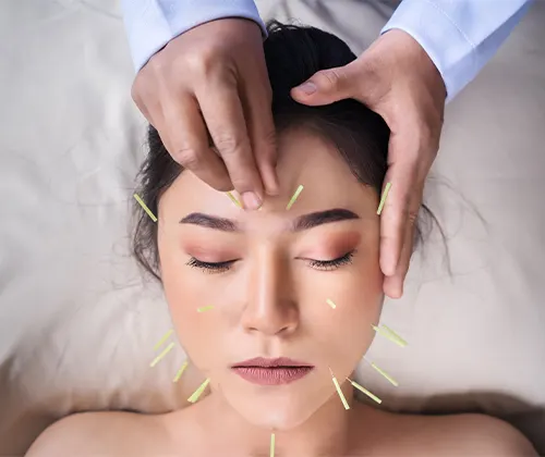 Acupuncture in Scarborough